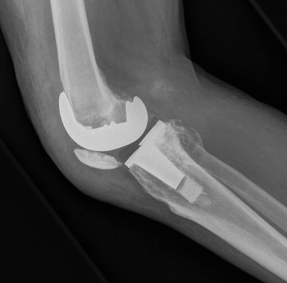 TKA Chronic Quadriceps Rupture